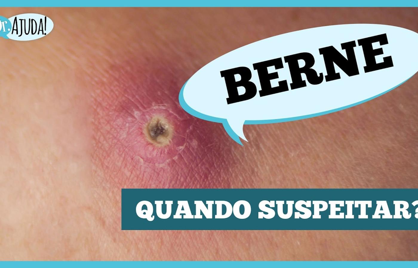 Berne: parece uma espinha, mas pode ser uma larva na pele
