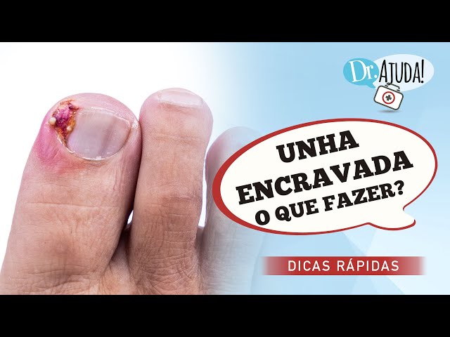 Unha encravada: o que fazer?